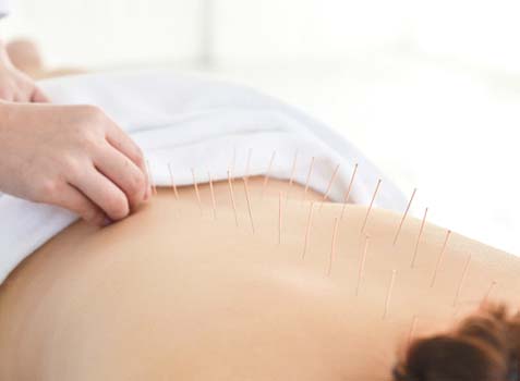 Professional carefully inserting needles into patient’s back during medical acupuncture session